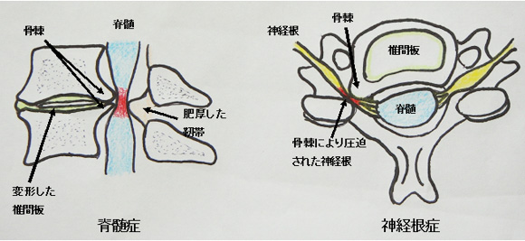 脊髄症・神経根症