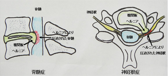 脊髄症・神経根症