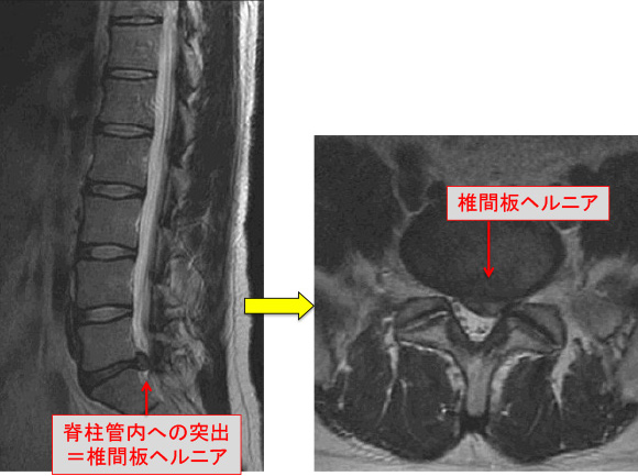 腰椎椎間板ヘルニア