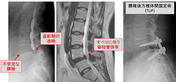 腰椎すべり症