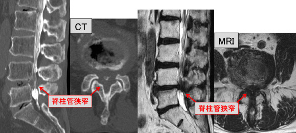 腰部脊柱管狭窄症