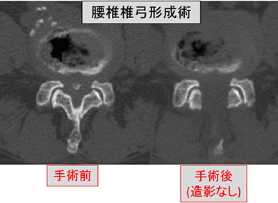 腰椎すべり症