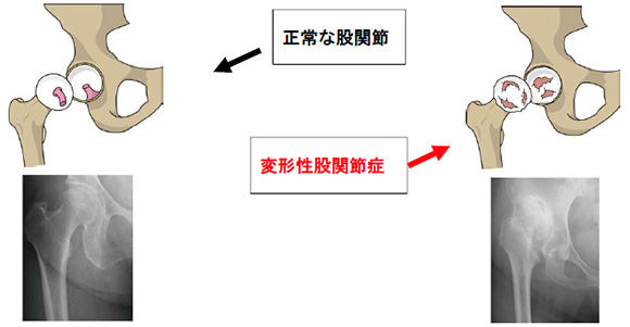 変形性股関節症とは